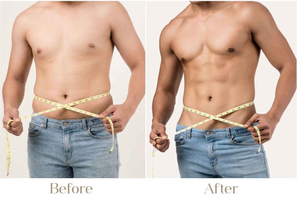 Fat Loss Treatment for Men in Delhi