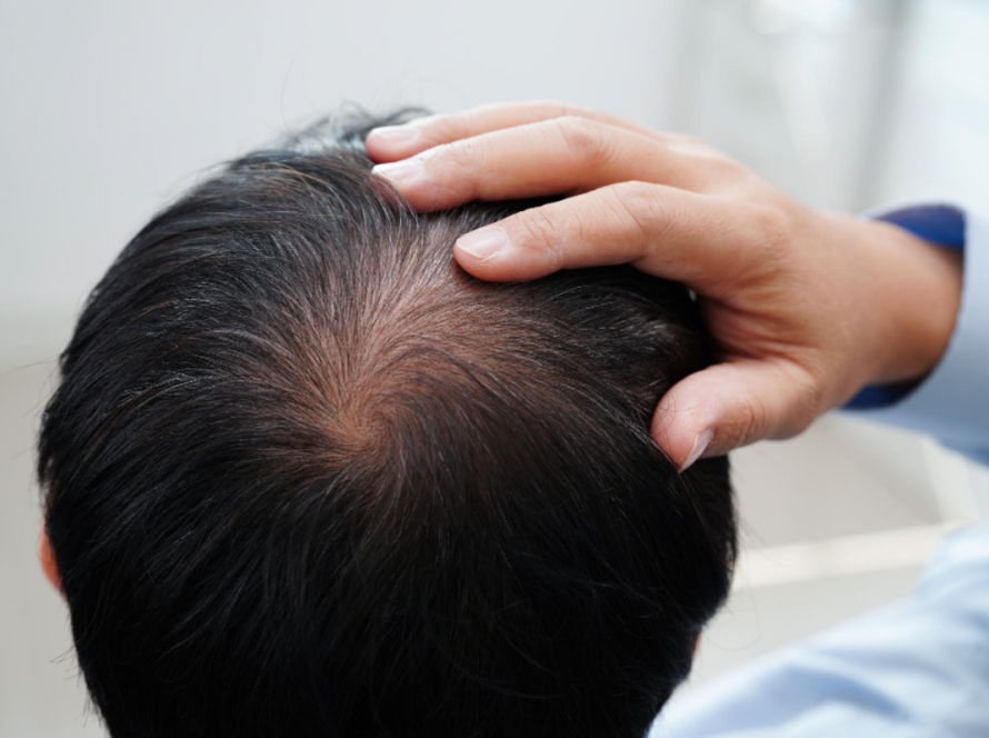 Hair Loss Treatment for Men in Delhi