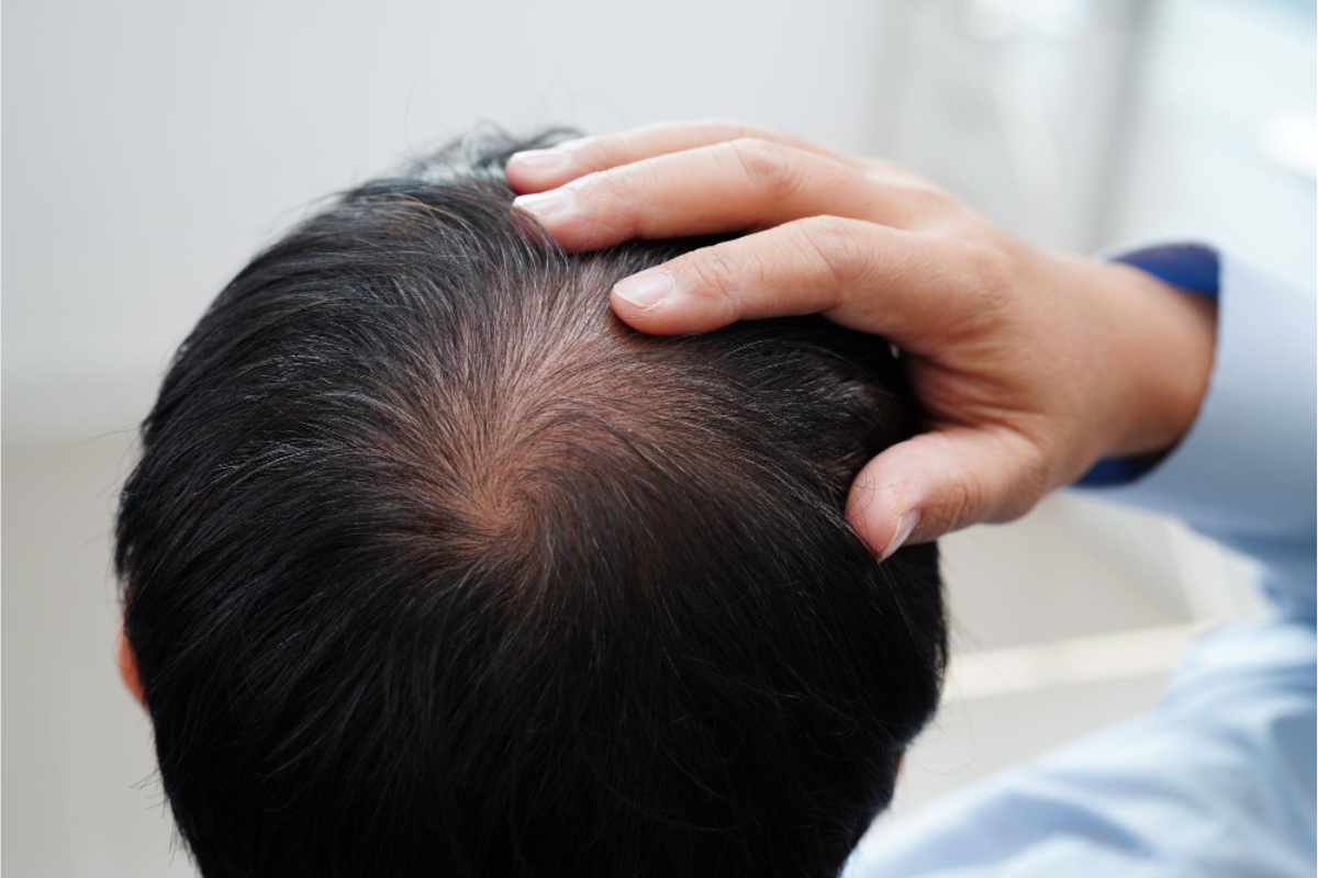 Hair Loss Treatment for Men in Delhi