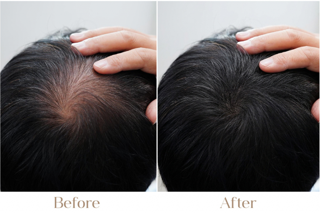 Hair Loss Treatment for Men in Delhi