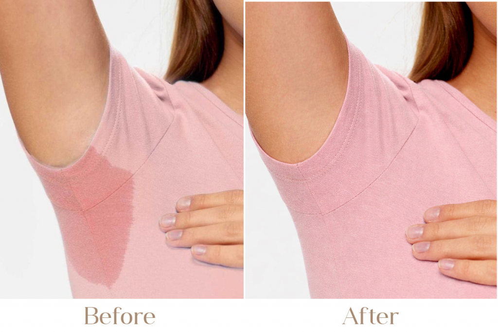 Hyperhidrosis Treatment in Delhi