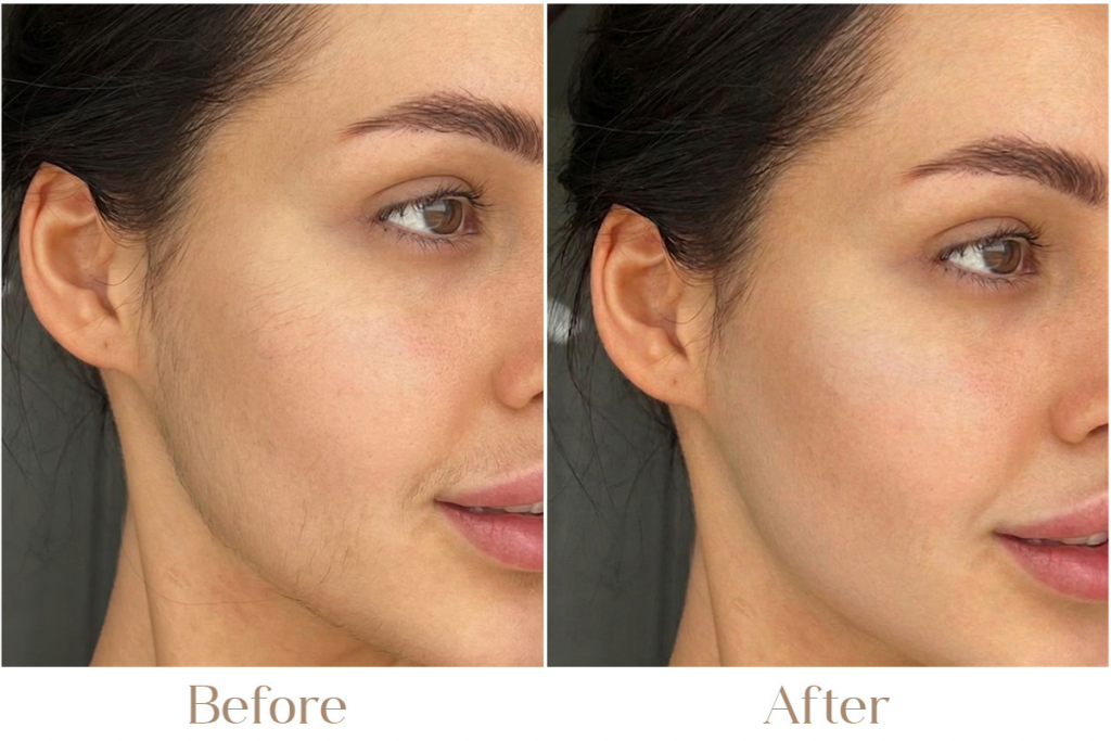 Laser Facial Hair Removal in Delhi