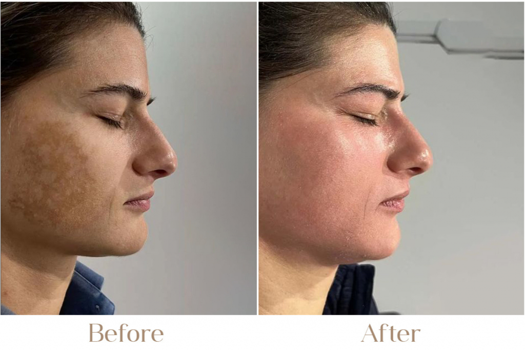 Laser Toning Treatment in Delhi