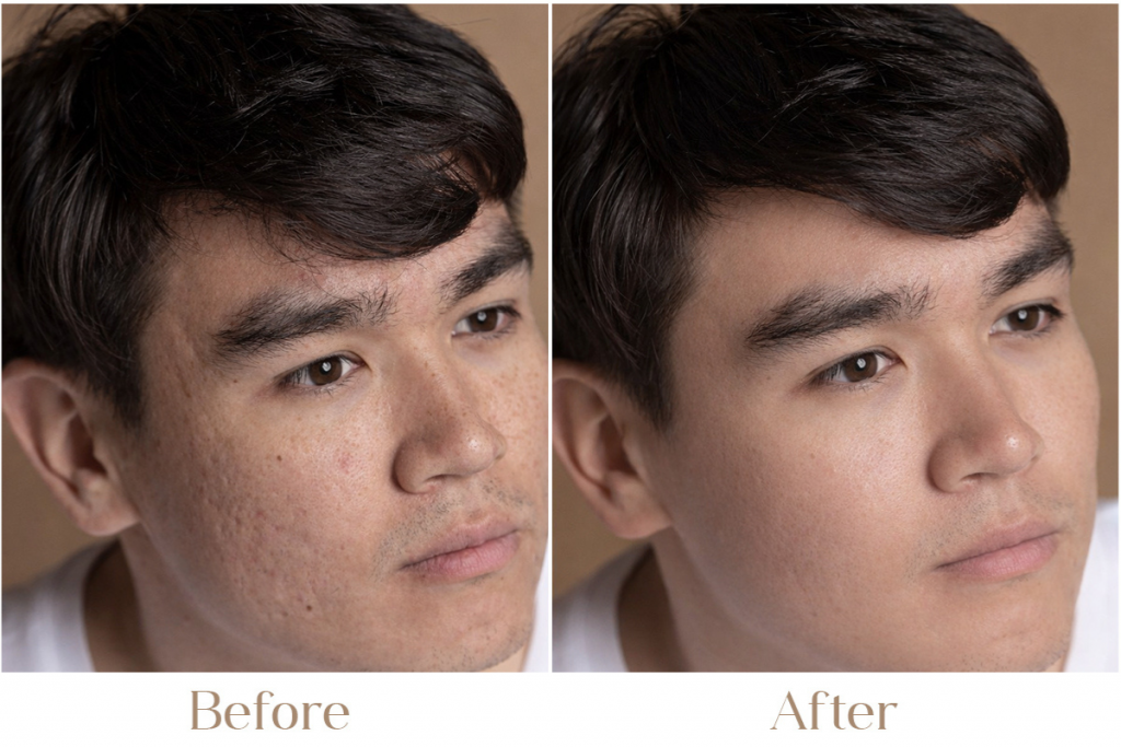 PRP Treatment in Delhi