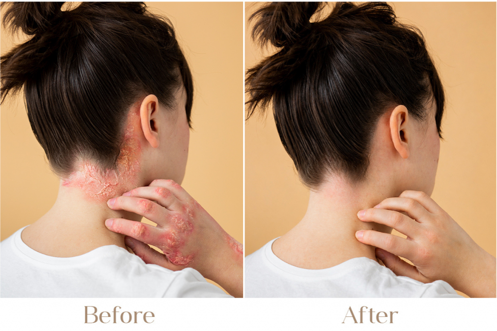 Psoriasis Treatment
