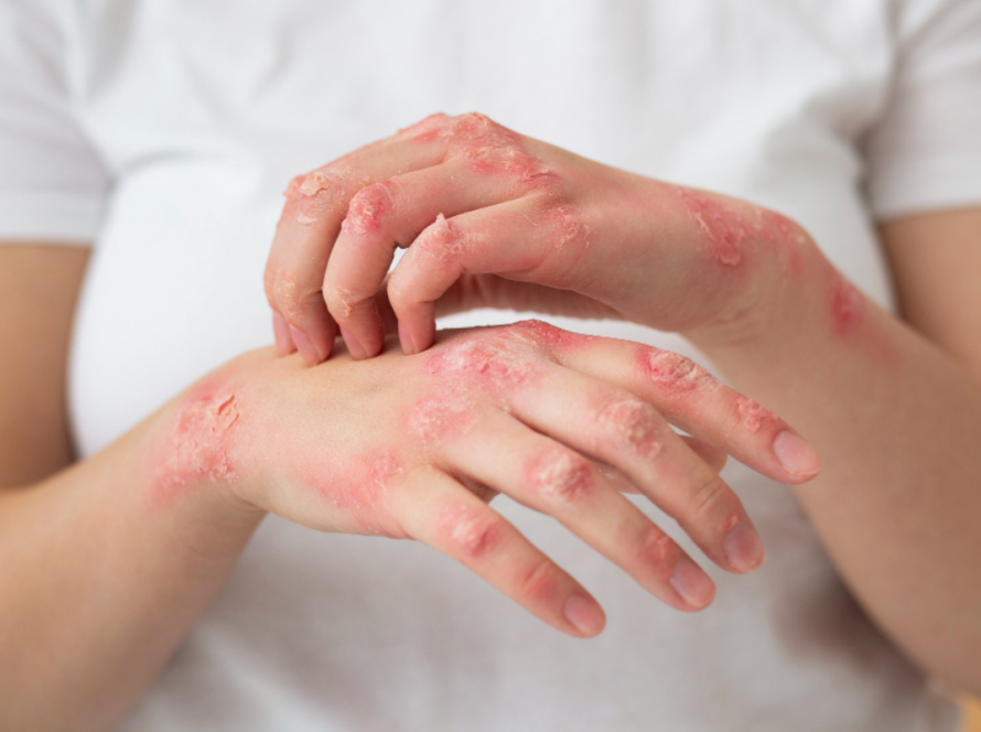 Psoriasis Treatment