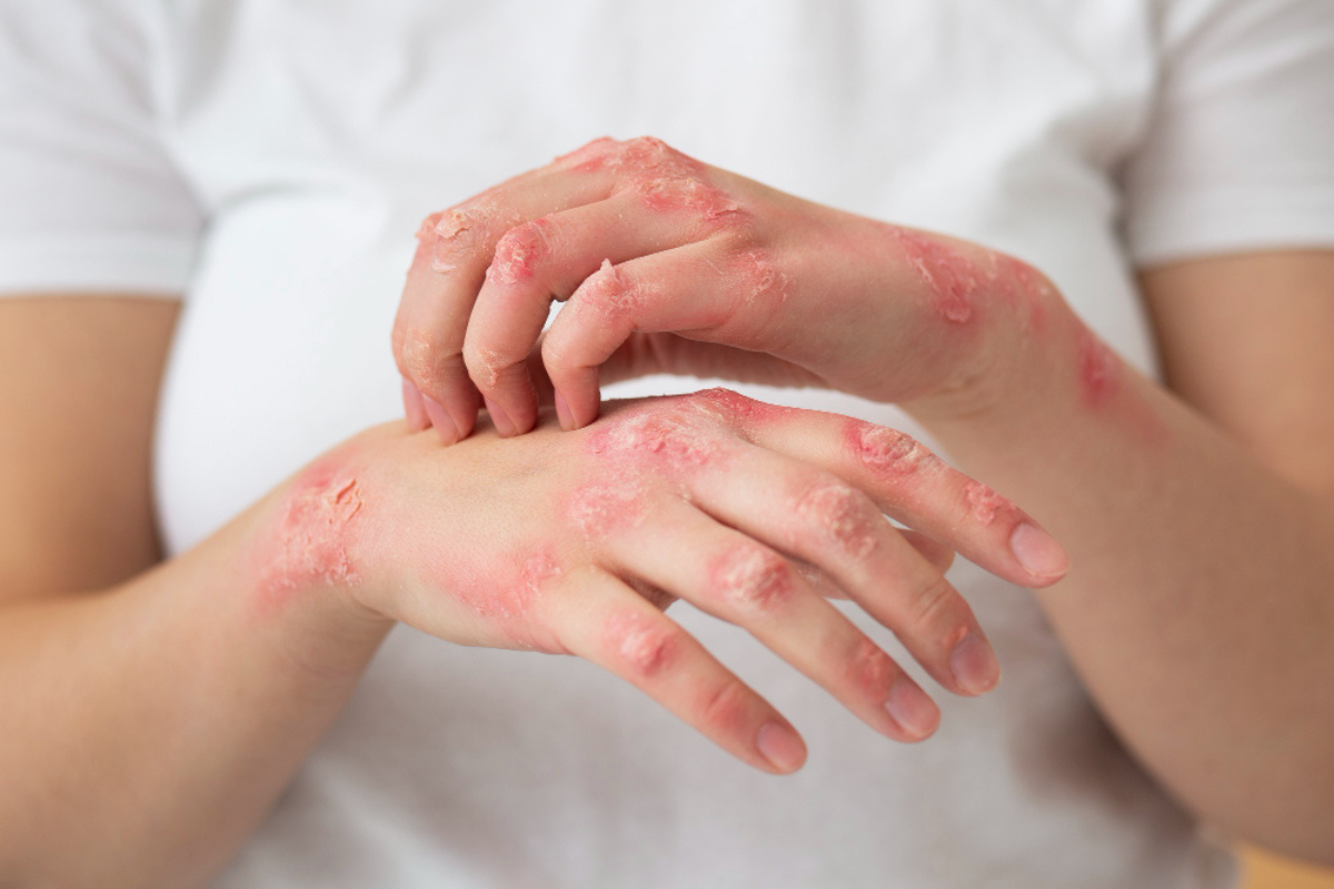 Psoriasis Treatment