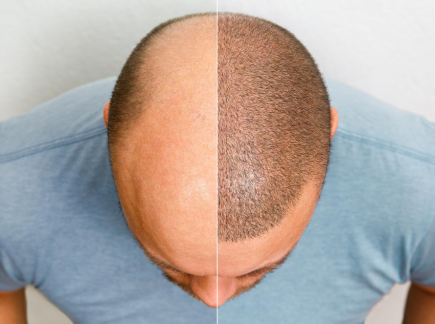Scalp Micropigmentation in Delhi