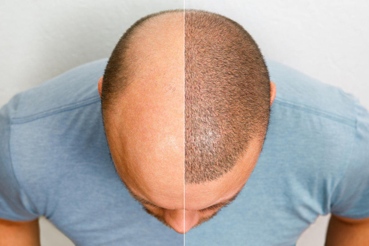 Scalp Micropigmentation in Delhi