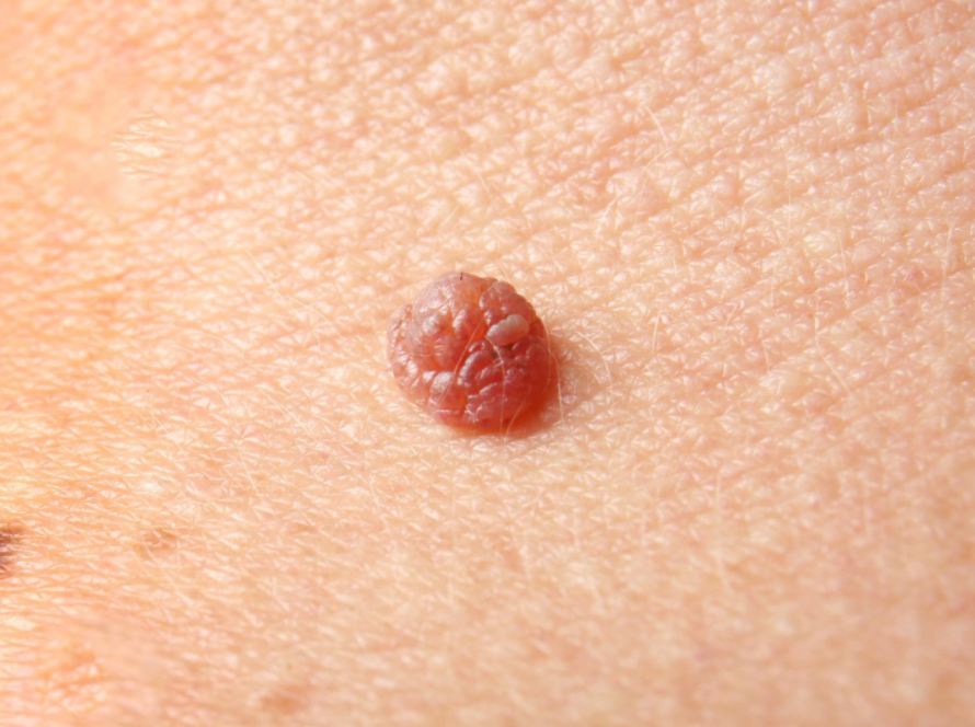 Skin Tag Removal in Delhi