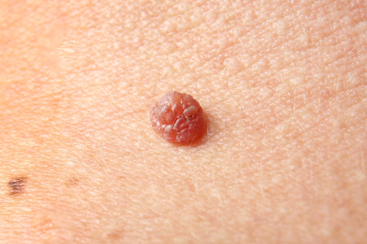 Skin Tag Removal in Delhi