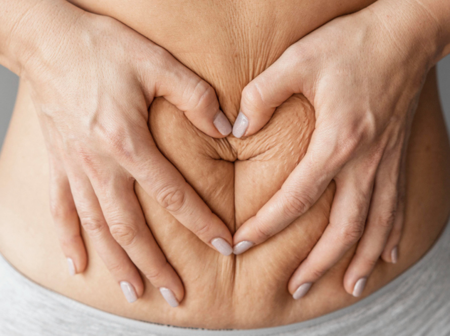 Stretch Mark Treatment in Delhi