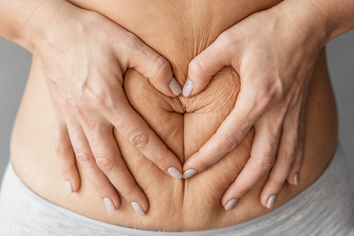 Stretch Mark Treatment in Delhi