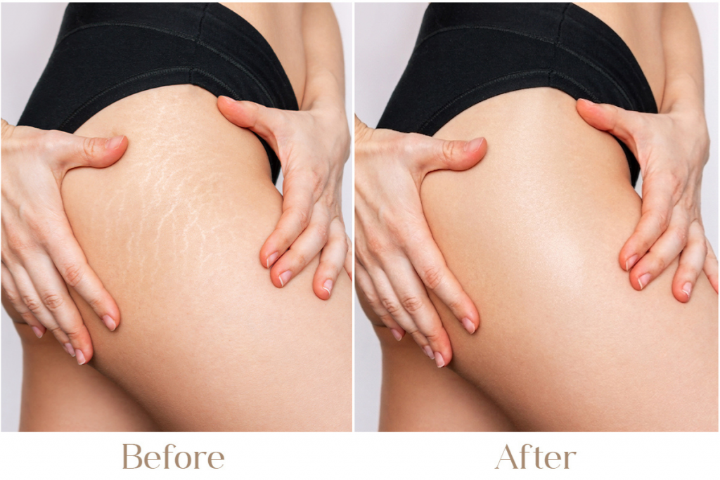 Stretch Mark Treatment in Delhi