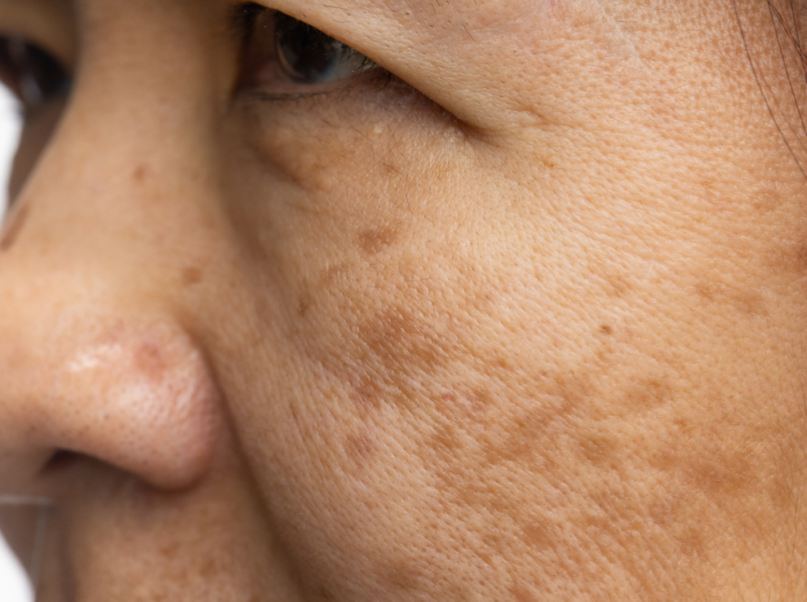 Melasma Treatment in Delhi