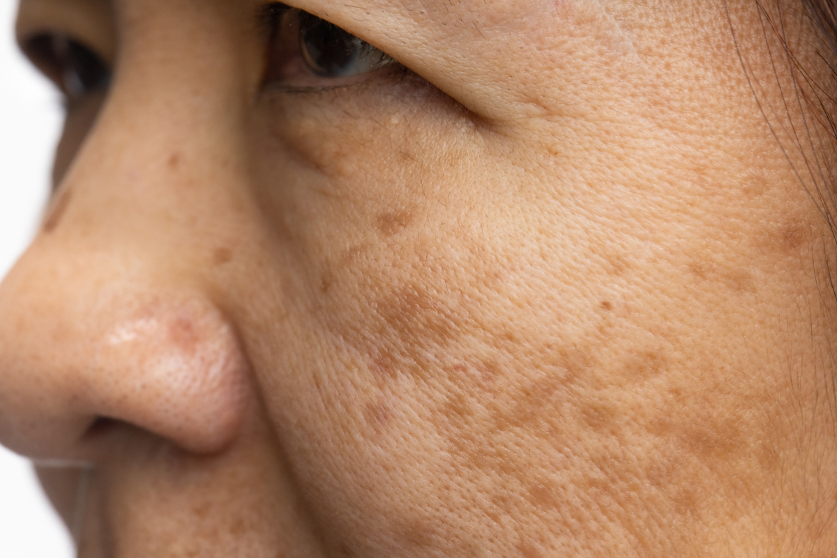 Melasma Treatment in Delhi