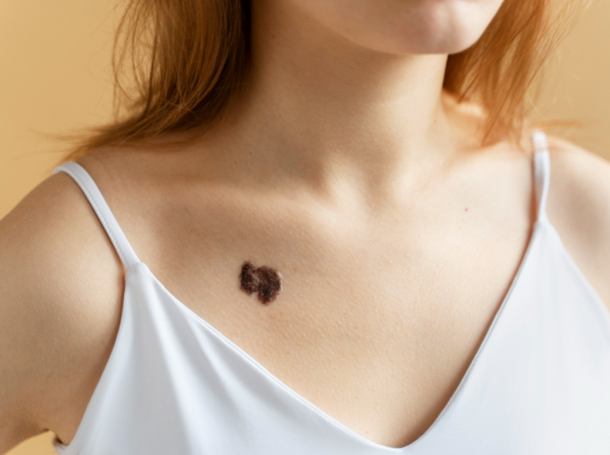 Skin Tag Removal in Delhi