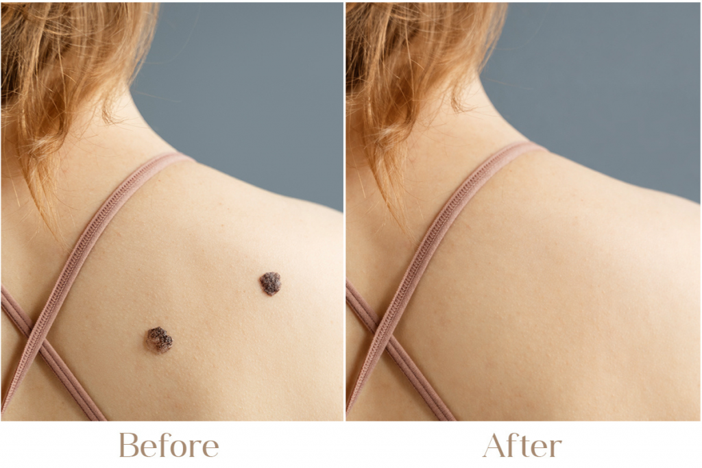 Skin Tag Removal
