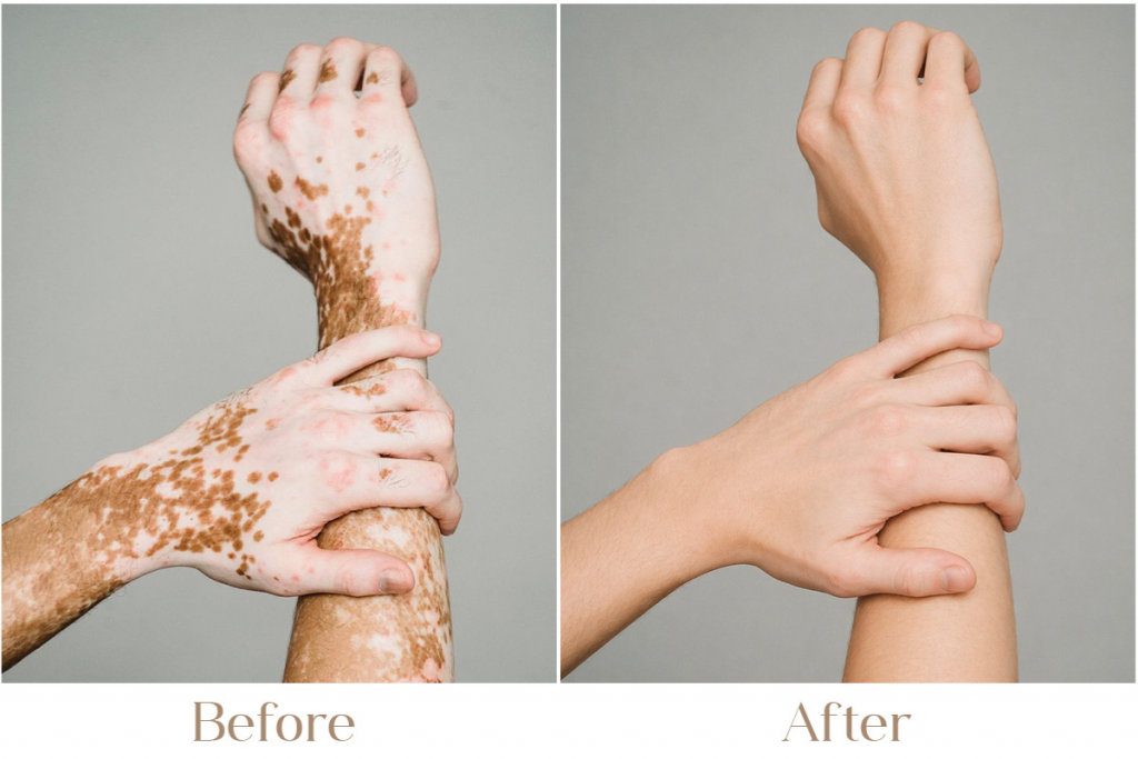 Vitiligo Treatment in Delhi