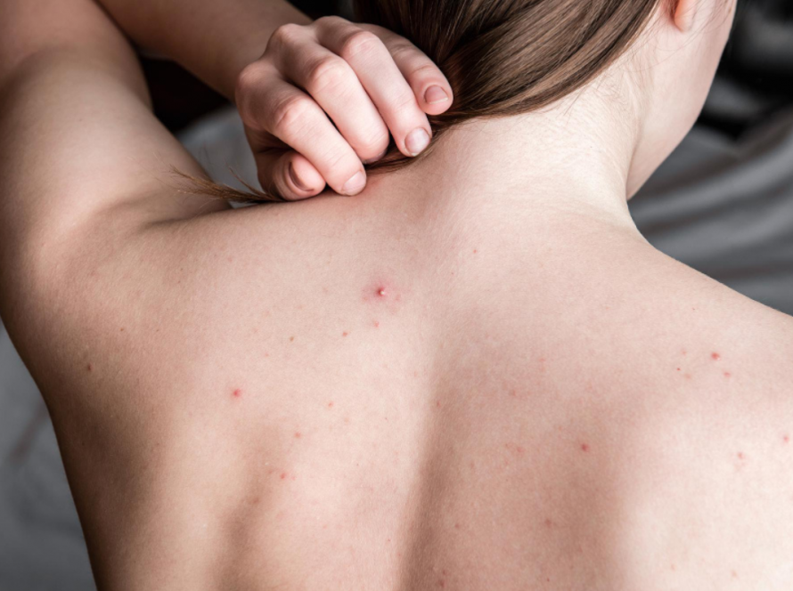 Back Acne Treatment in Delhi