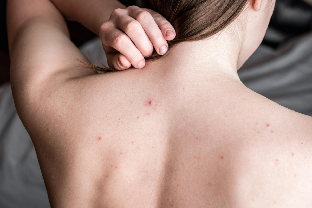 Back Acne Treatment in Delhi