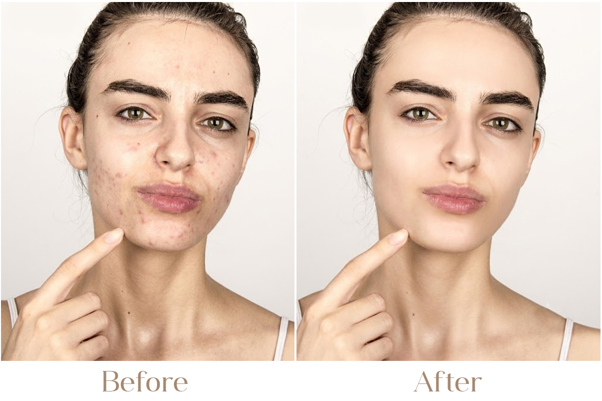 Top Causes of Adult Acne in Women