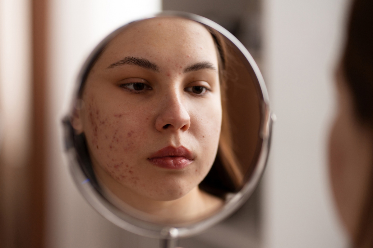 What Are the Main Causes of Acne?